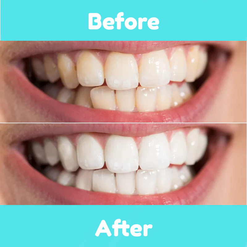 ORAL MAX - PRO TEETH WHITENING BUNDLE - Image 3